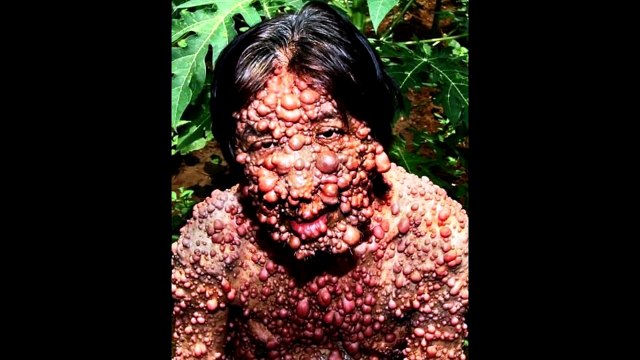 Dünya Üzerindeki En İlginç 5 Hastalık ( Biraz Korkunç Olabilir)