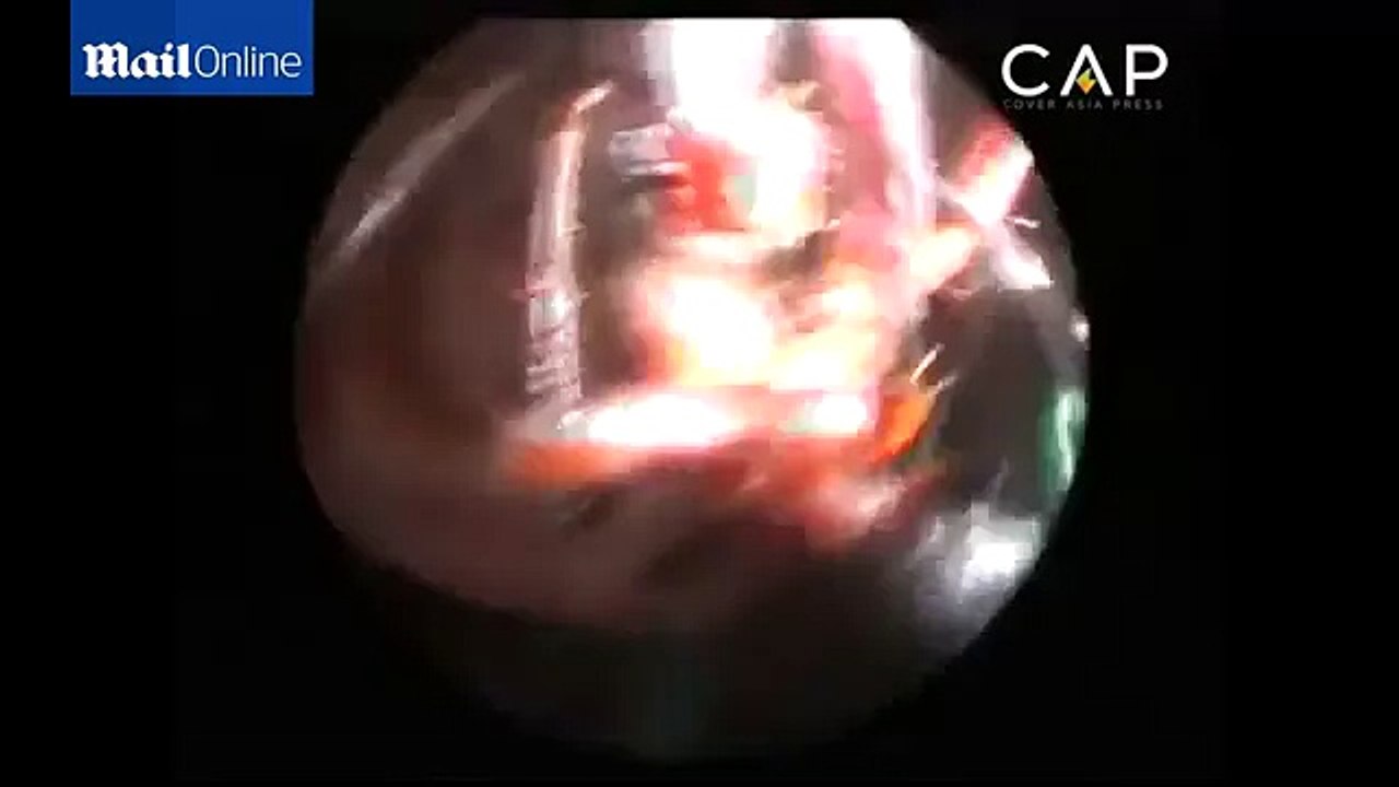 12 year old girl in India has an ant nest inside her ear
