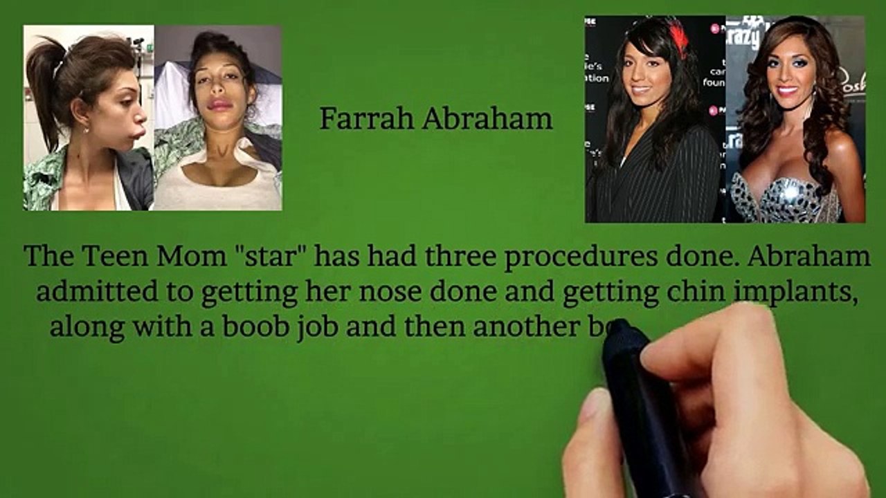 5 Worst Celebrity Plastic Surgeries