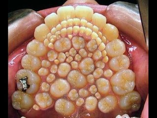 Полиодонтия