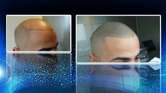 Scalp Micropigmentation Demonstration - Headpower Hair Clinic