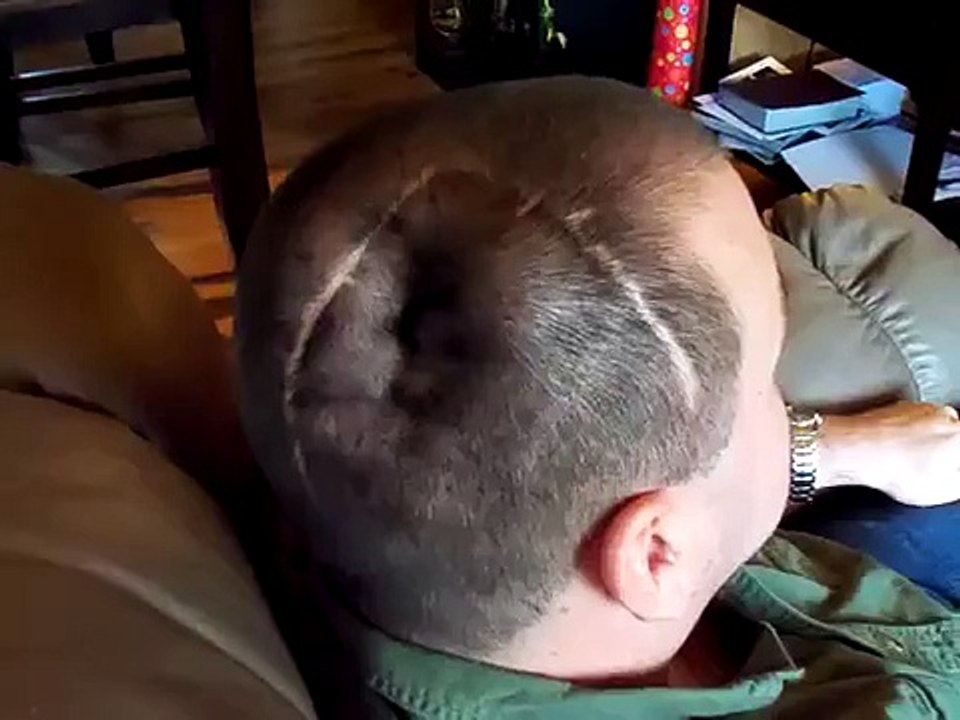 if you do not have a titanium plate in head