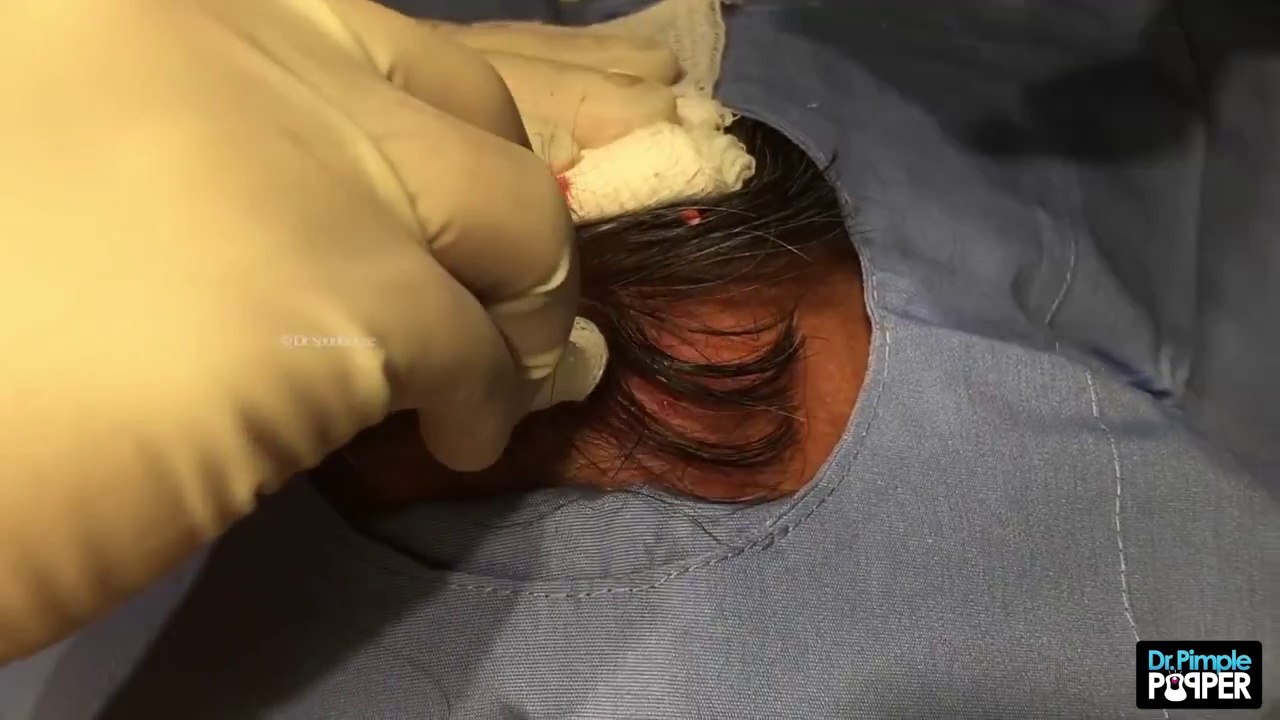 Removing this Large Growth on the Frontal Scalp of a very nervous patient