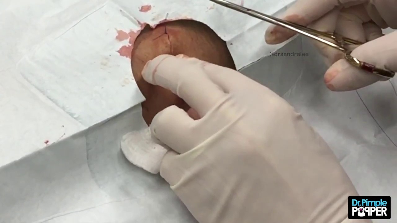 What kind of cyst is this-! Part 2 of 3
