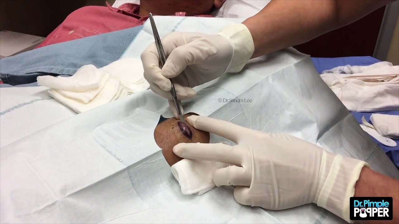 What kind of Cyst is This-! Part 3 of 3