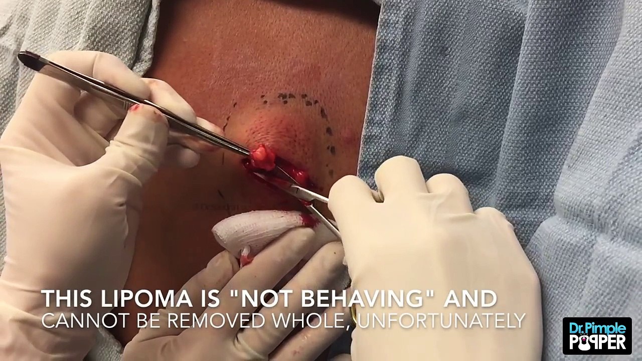 A Difficult Lipoma to remove from the Upper Back