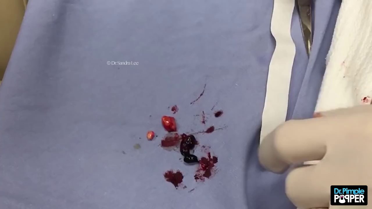 An interesting POP on the elbow