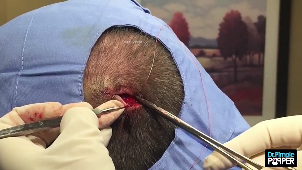 Is this a cyst on the scalp- To be continued...