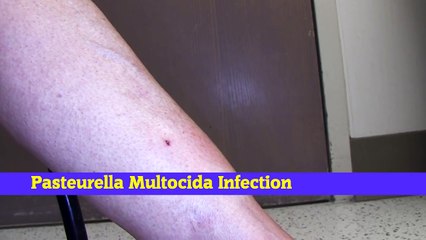 Understanding P. Multocida Cat Scratch Infection 🐱: Symptoms, Treatment, and Prevention