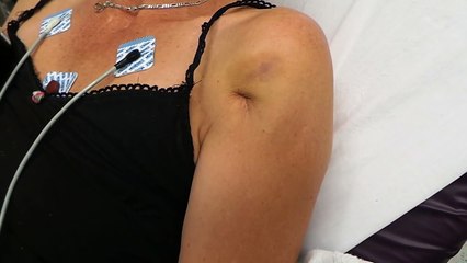 Understanding the Pucker Sign in Surgery 🏥