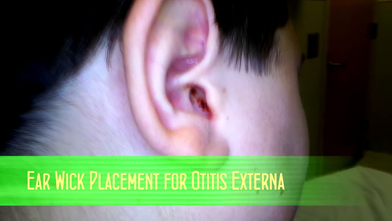 Ear Wick Placement for Otitis Externa video Dailymotion