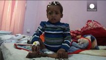 Jemen: Weit über eine Million Kinder wegen der Kämpfe unterernährt