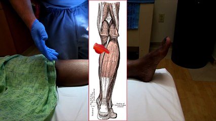 How to Examine for the Injured Soleus Muscle