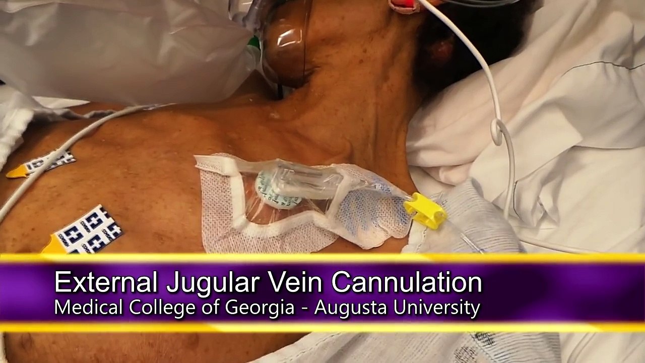 External Jugular Vein Cannulation