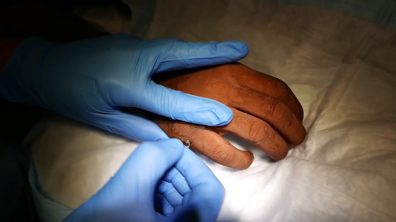Kirschner Wire Removal Procedure
