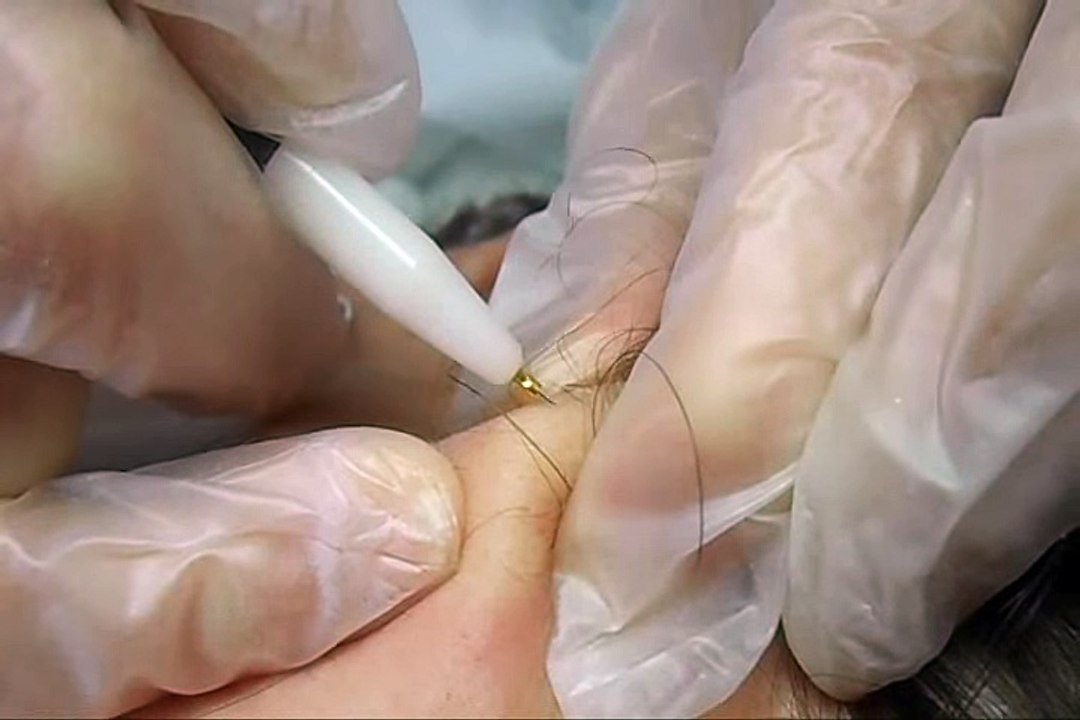 Electrology. Pinch Technique