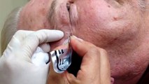 Extracting blackheads comedones in condition called Favre-Racouchot For medical education- NSFE.