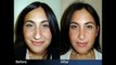 Rhinoplasty Before & After Plastic Surgeon New York