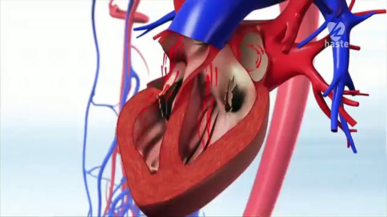 How does Atrial Fibrillation causes stroke