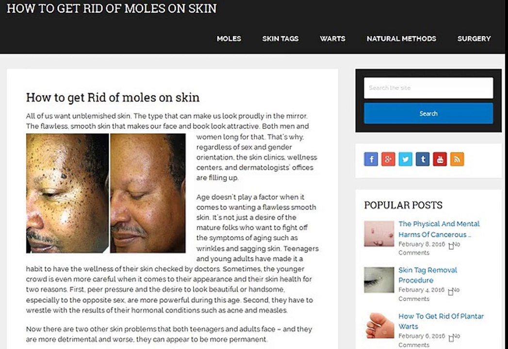 How to remove moles from face