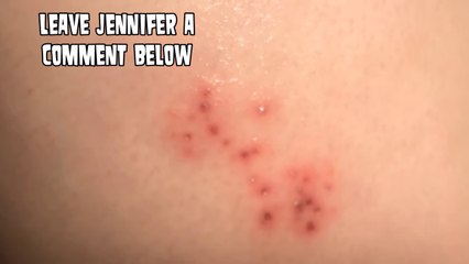 Staph Infection, Pimples or Poison Ivy Which is it