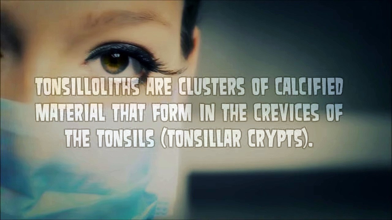 Tonsilloliths, Tonsil Stone Removal & Popping - Do Vegans Get Them