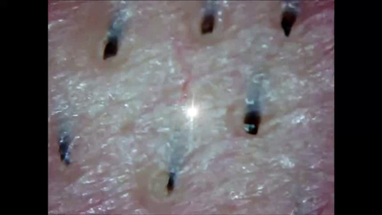 What is in pimples