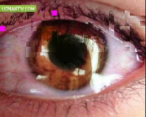 Göz Sulanması Niye Olur?