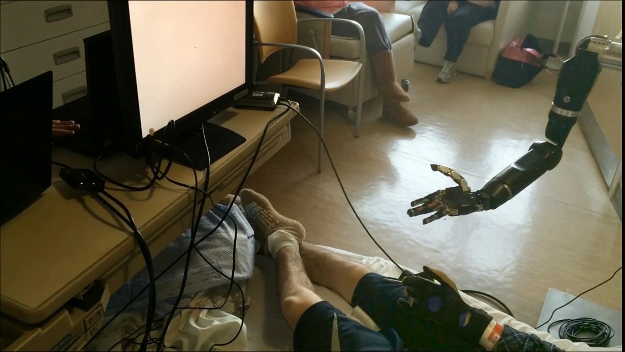 Mind-Controlled Prosthetic Arm Moves Individual ‘Fingers’