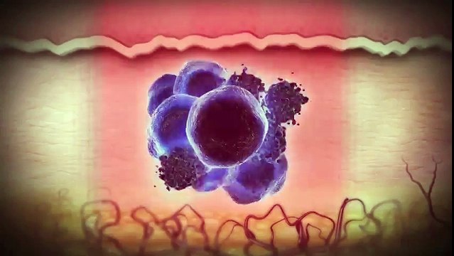 PicoSure Tattoo Removal at SILK Laser Clinics