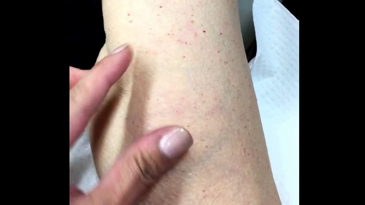 Dr Sandra Lee removes a lipoma from the forearm...