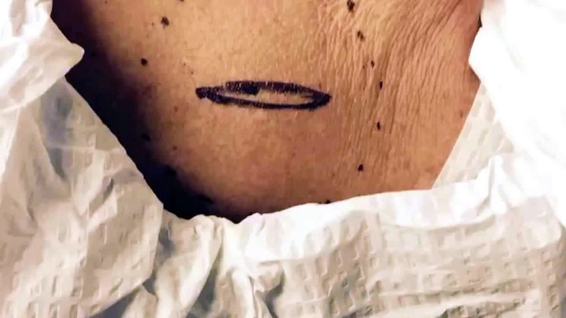 ⁣Excision of a lipoma on the upper back. For medical education- NSFE.