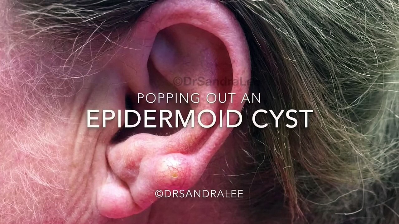 Ear cyst POPPED. For medical education- NSFE.