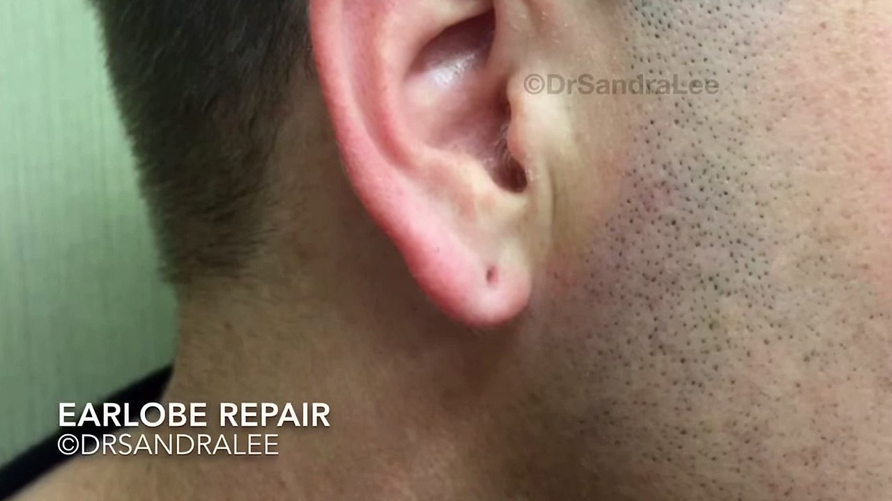 Earlobe repair from plugs that dilated pierced...