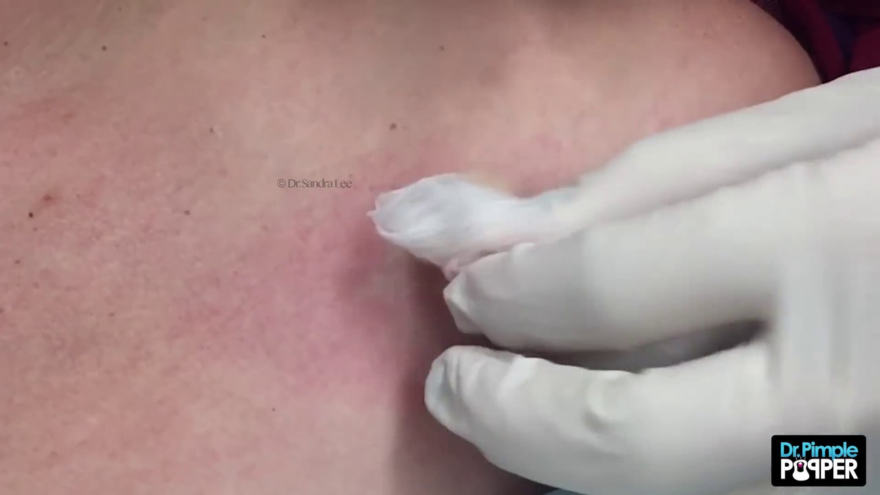 Il perce un vieux bouton au scalpel