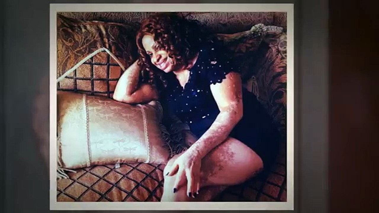 All Natural Vitiligo Treatment System