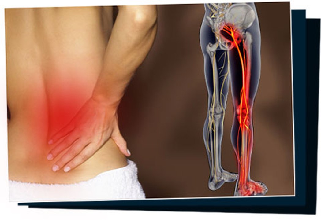 Comment Soigner Une Sciatique