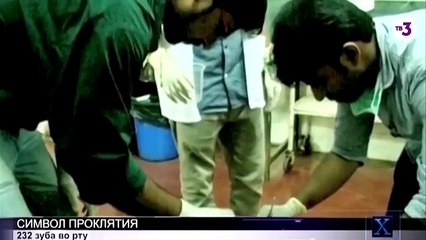 232 лишних зуба у индийского подростка