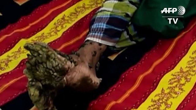 Bangladesh's 'Tree Man' undergoes successful surgery