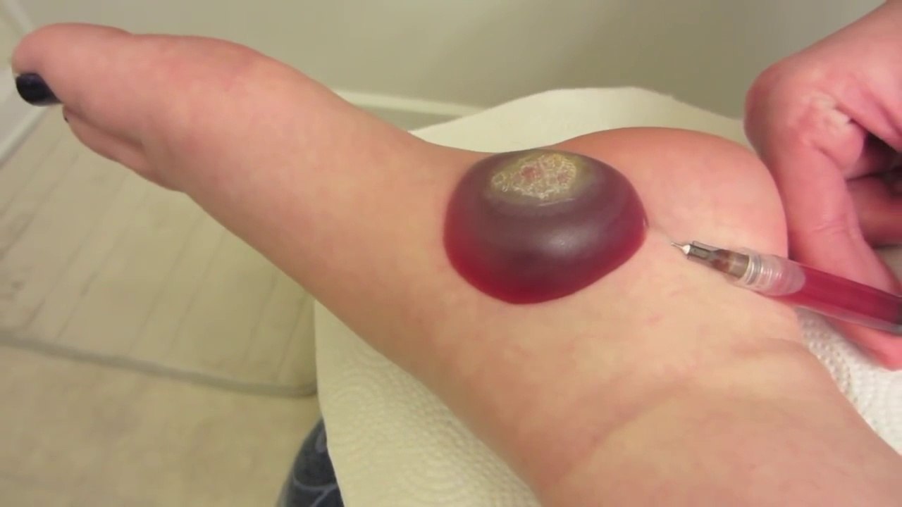 BIG wart blister after freezing with liquid nitrogen