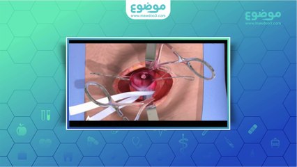 علاج الفتق الاربي