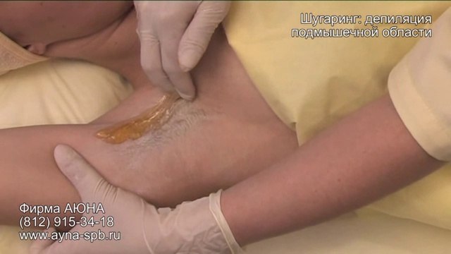 Шугаринг АЮНА- депиляция подмышечной области