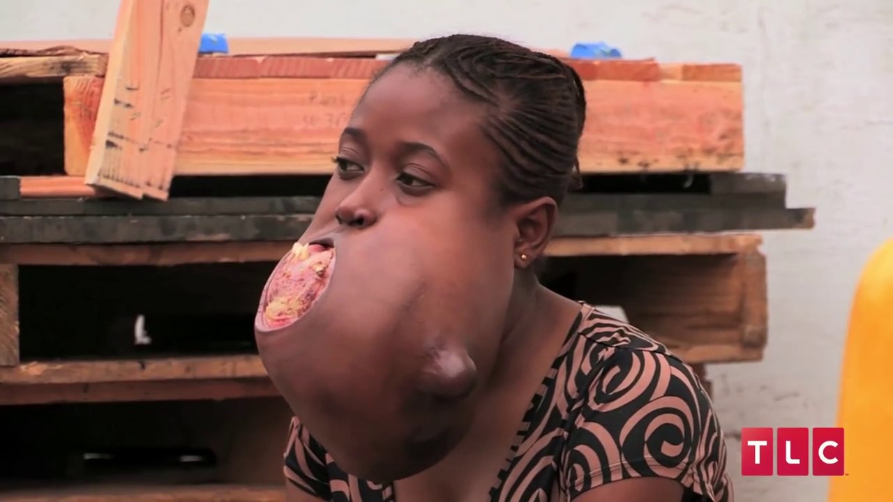 Girl Has Football-Sized Tumour On Her Face Body Bizarre Episode 6