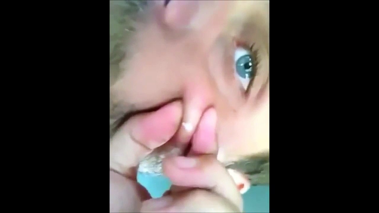 zit popping
