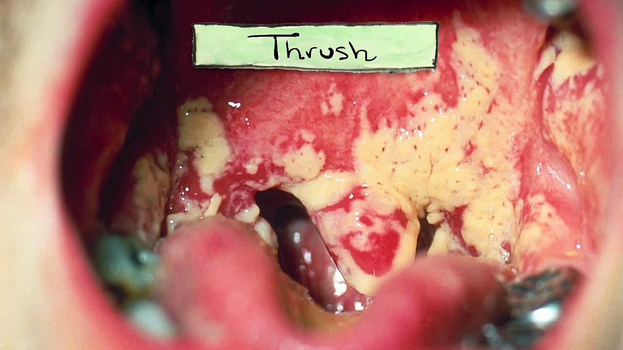 What Really Causes Cavities