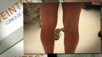 Mejor cirugía de la vena Laser Clinic en Cd. Obregón