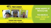 Hair Transplant Surgery in Ludhiana at First choice Hair Transplant & Cosmetics clinic