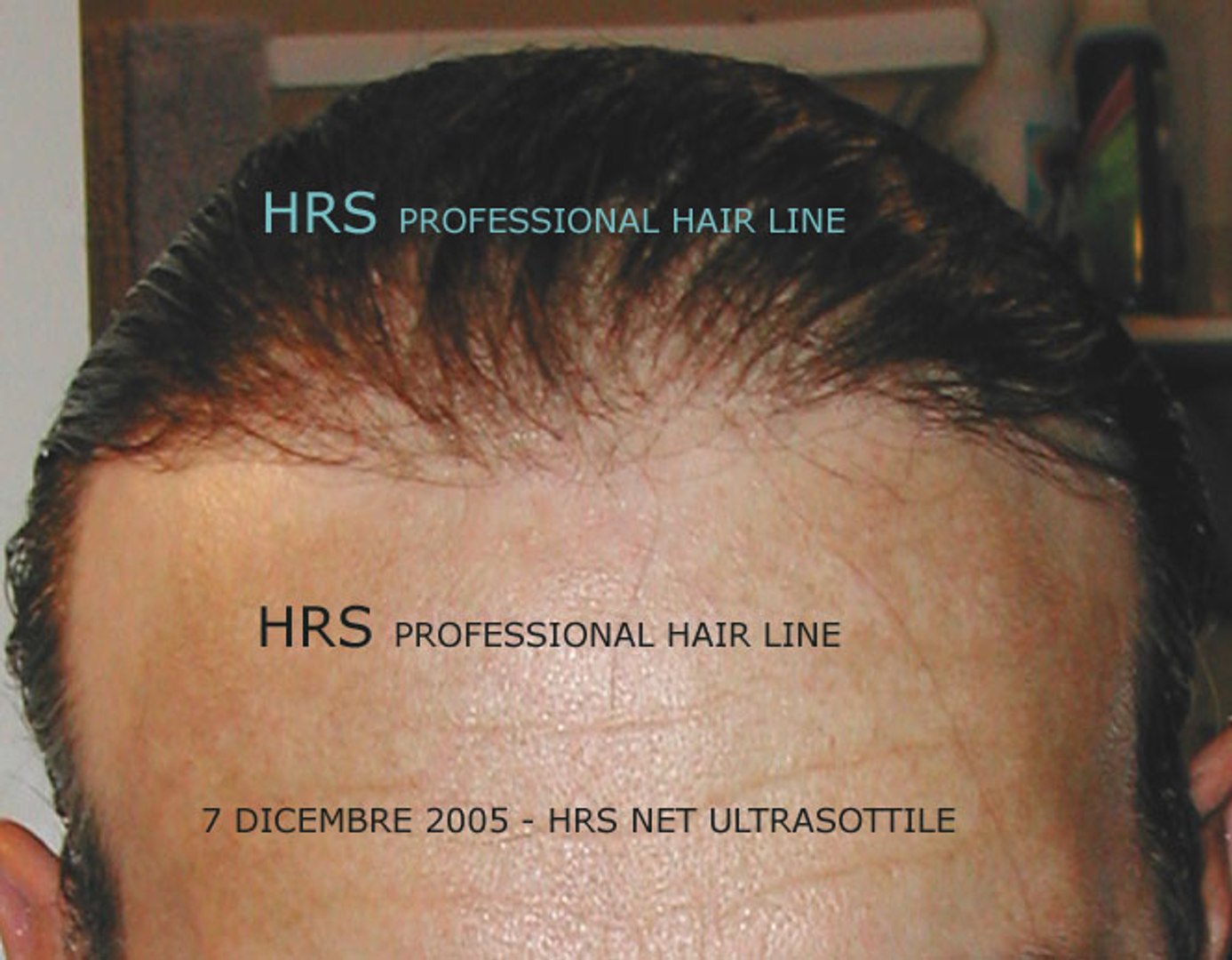 protesi capelli hrs