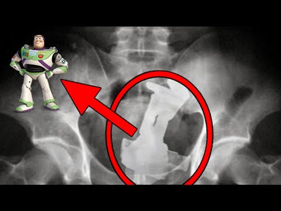 5 MOST BIZARRE Items Found Inside People!
