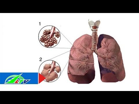 Xơ phổi: Căn bệnh không thuốc chữa | LTV